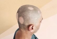 Які різні типи алопеції ареата?