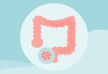 8 розвінчаних міфів про рак товстої кишки: поради щодо профілактики та раннього виявлення