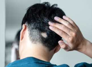 Нові та майбутні прориви в лікуванні гніздової алопеції