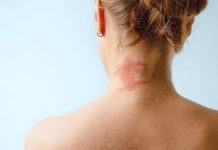 Коли екзема не реагує на стероїди: дослідження альтернативних методів лікування