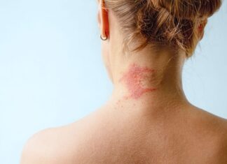 Коли екзема не реагує на стероїди: дослідження альтернативних методів лікування