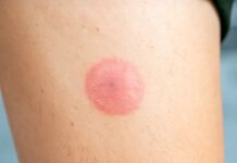 Укуси кліщів: що вам потрібно знати про виявлення, симптоми та профілактику