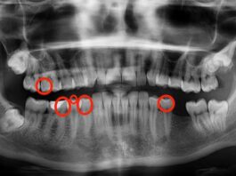 Як я позбавив 5 карієсів за 3 місяці: мій особистий підхід до ремінералізації