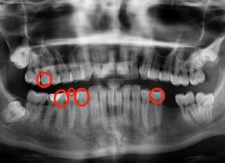 Wie ich 5 Karies in 3 Monaten rückgängig gemacht habe: Ein persönlicher Ansatz zur Remineralisierung