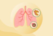 Бронхоэктатическая болезнь: Полный обзор симптомов, причин и лечения