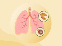 Бронхоэктатическая болезнь: Полный обзор симптомов, причин и лечения