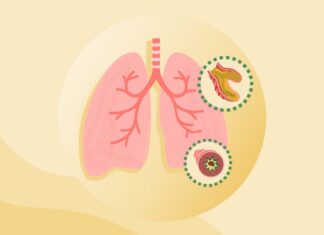 Бронхоэктатическая болезнь: Полный обзор симптомов, причин и лечения