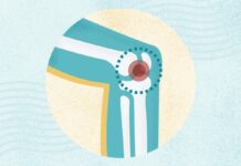 Остеоартрит: Понимание Симптомов, Причин и Методов Лечения