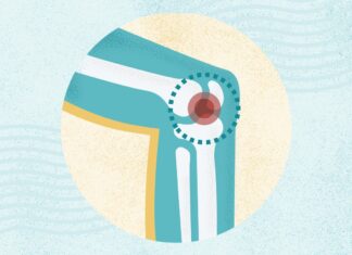 Остеоартрит: Понимание Симптомов, Причин и Методов Лечения