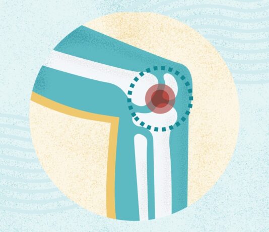 Остеоартрит: Понимание Симптомов, Причин и Методов Лечения